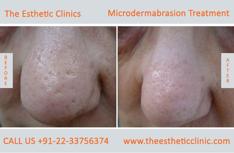 Microdermabrasion Dermabrasion Treatment before after photos in mumbai india (2)